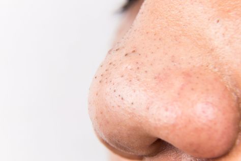 Blackheads and Clogged Pores Are Not the Same Thing What Causes Blackheads, Blackheads On Cheeks, What Are Blackheads, Skincare Ideas, Blackhead Remedies, Blackheads On Nose, Natural Acne Remedies, How To Get Rid Of Pimples, Get Rid Of Blackheads