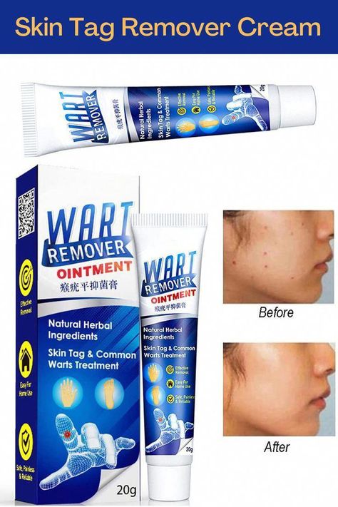 #AllNaturalHomeRemedies #NaturalHealthVitamins Home Remedies For Warts, Warts Remedy, Wart Remover, Tag Remover, Cold Medicine, Home Remedy For Cough, Cold Sores Remedies, Skin Tags, Natural Sleep Remedies