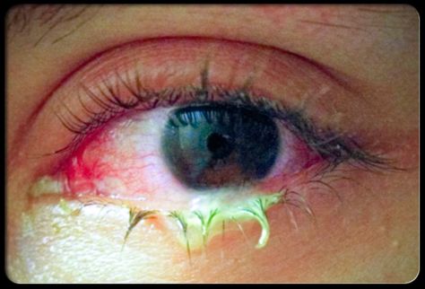 Picture of Pink Eye Treating Pink Eye, Pink Eye Home Remedies, Natural Pink Eye Remedy, Pinkeye Remedies, Eye Infections, Eye Pictures, Sore Eyes, Pink Eye, Eyes Problems