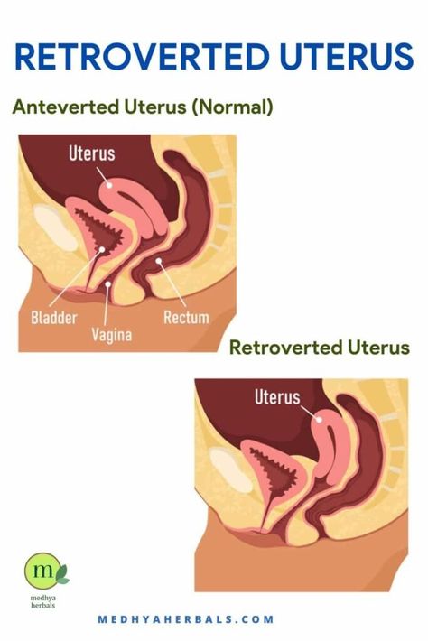 <p>An anteverted uterus, though it may sound complex, holds the key to understanding your reproductive health. If you’ve ever wondered, “Is an anteverted uterus good or bad?” or pondered the mysteries behind “anteverted uterus pregnancy bumps,” you’re in the right place. In this blog, we’ll decode the significance of an anteverted uterus, its potential impact […]</p> <p>The post <a rel="nofollow" href="https://medhyaherbals.com/anteverted-uterus... Retroverted Uterus Exercise, Uterus Diagram, Polyps Uterus, Tilted Uterus, Uterus Health, Retroverted Uterus, Bicornuate Uterus, Cramps During Pregnancy, Pregnancy Chart