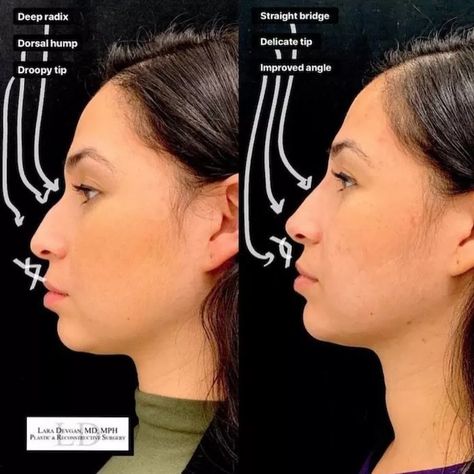 Liquid Nose Job, Liquid Rhinoplasty, Nonsurgical Nose Job, Nose Fillers, Facial Procedure, Anti Aging Skin Care Diy, Rhinoplasty Nose Jobs, Rhinoplasty Before And After, Injectables Fillers