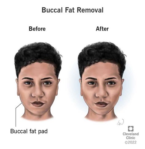 Buccal Fat Removal Exercises, Buccal Fat Removal, Cheek Fat, Double Chin Exercises, Medical Illustrations, Personal Trainer Certification, Chin Exercises, Facial Nerve, California State University