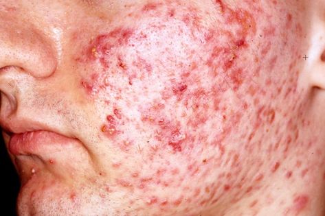 Dermatological Effects of Different Keratolytic Agents on Acne Vulgaris.@ http://www.omicsgroup.org/journals/dermatological-effects-of-different-keratolytic-agents-on-acne-vulgaris-2167-0870-1000262.php?aid=71859 Homemade Acne Mask, Proper Skin Care Routine, How To Reduce Pimples, Acne Mask, Acne Vulgaris, Face Care Routine, Cystic Acne, Laser Therapy, Skin Remedies