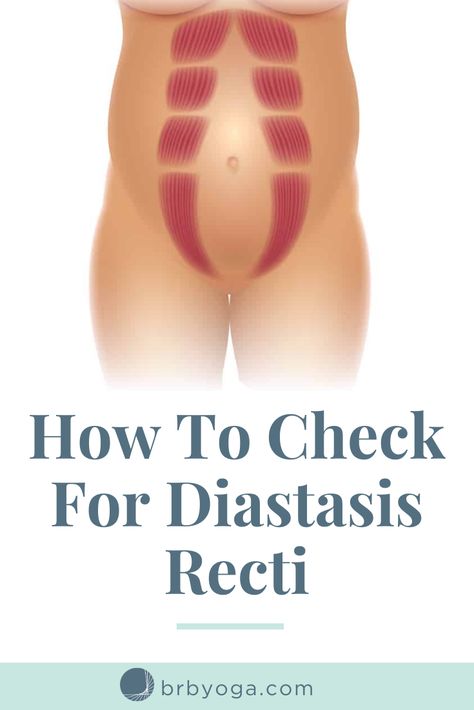 Abdominal Rectus Diastasis Recti, Diasis Recti, Diastasis Recti Before After, Diastis Recti Exercises, Diastis Recti, Pregnancy Core Workout, Diastasis Recti Repair, Postpartum Yoga, Healing Diastasis Recti