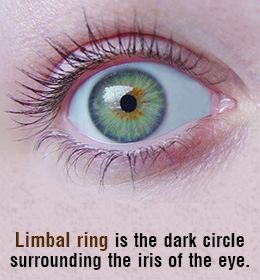 Limbal rings reduce as we age Limbal Ring Eye, Limbal Ring, Ring Meaning, Dark Ring, Rings With Meaning, Eye Meaning, Dark Rings, Normal Guys, Dark Circles