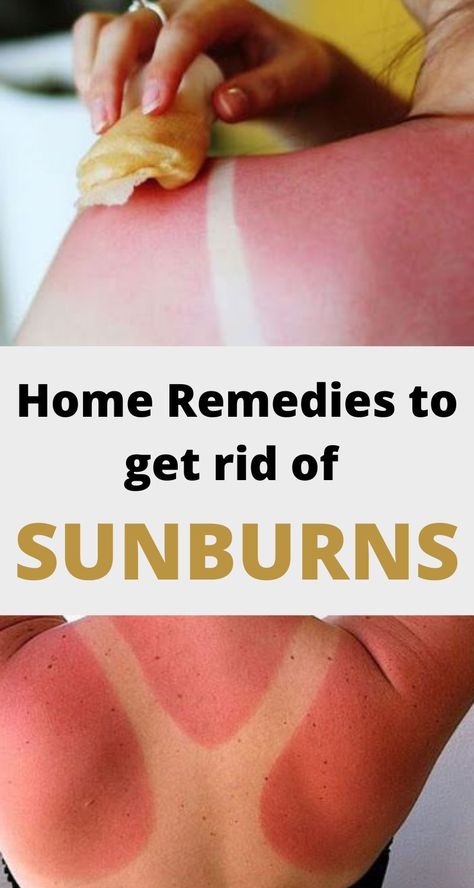 Home Remedies and Treatments to get rid of Sunburns fast Diy Sunburn Remedies, Bad Sunburn Remedies, Quick Sunburn Remedies, How To Get Rid Of A Sunburn Fast, How To Heal Sunburn Fast, Sun Burn Remedy, Heal Sunburn Fast, Sunburn On Face, Vinegar For Sunburn