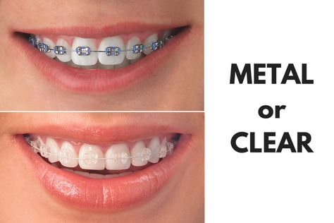 Clear Braces Vs Metal, Lingual Braces, Ceramic Braces, Braces Cost, Types Of Braces, Adult Braces, Invisible Braces, Cute Braces, Clear Braces