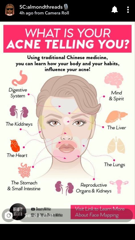 Gesicht Mapping, Face Mapping Acne, Face Mapping, Acne Treatments, Acne Causes, Beauty Tips For Face, Acne Breakout, Face Acne, Image Skincare