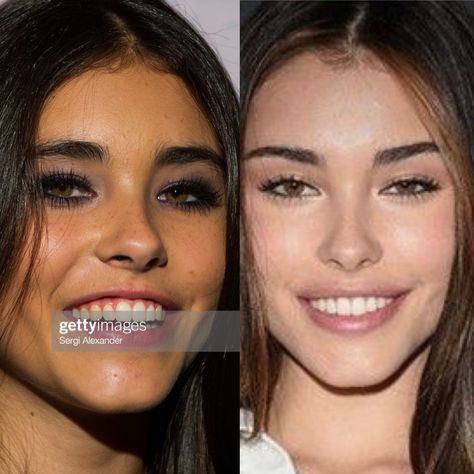 Madison Beer plastic surgery before and after Madison Beer Lip Fillers, Madison Beer Lips, Madison Beer Plastic Surgery, Jaw Filler, Lip Lift Surgery, Botox Lip Flip, Filler Face, Foxy Eye, Secret Aesthetic