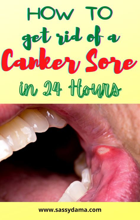 Natural Canker Sore Remedies, Diy Canker Sore Remedy Fast, Essential Oil For Canker Sore In Mouth, Cold Sore Inside Mouth Remedy, How To Heal A Canker Sore Fast, How To Get Rid Of Canker Sore In Mouth, Mouth Sore Relief, Sores In Mouth Remedies, How To Get Rid Of A Canker Sore Fast