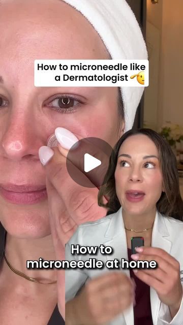 Lindsey Zubritsky, MD, FAAD on Instagram: "It's time to ditch your dermaroller...because your skin deserves better!

Maybe you’ve heard of the power of at-home micro-needling, and how it can help your skin boost collagen and product absorption.

But do you know how much damage some devices can cause your skin?

Micro-needle rollers, or “derma rollers” DRAG across your skin. Causing unnecessary damage and irritation that takes days to recover from.

Qure's Micro-Infusion “stamping” method is typically more effective and safer than derma rolling with minimal to no downtime.

This stamping technique creates CLEAN “micro channels” that directly infuses serum into skin to increase absorption.

Click the link below now to SAVE 43% with the limited-time offer 👇
https://www.qureskincare.com/pages Dermarolling Stomach, Micro Needling Before And After, Derma Stamp, Derma Rolling, Micro Needling, Micro Needle Roller, Derma Pen, Micro Needle, Boost Collagen