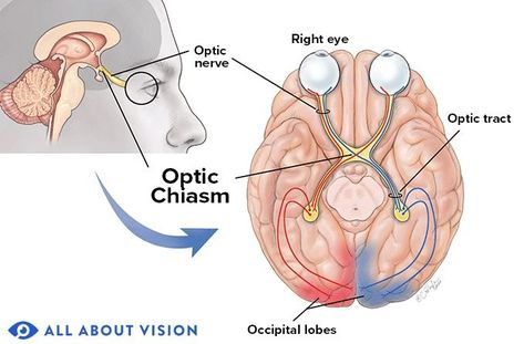 Optic Chiasm - All About Vision Corneal Abrasion, Glasses For Round Faces, Eye Anatomy, Eye Twitching, Eye Parts, Optic Nerve, Nerve Fiber, Soft Contact Lenses, Eye Safety