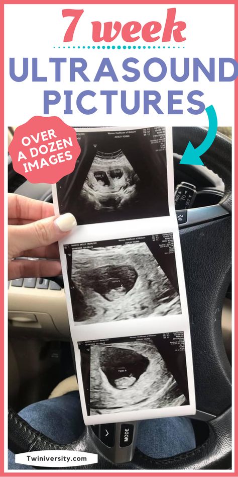 Curious how your ultrasound matches up with others? Take a look at over a dozen images of 7 week ultrasound pictures! 7 Week Ultrasound, Twin Ultrasound At 12 Weeks, Twins Ultrasound, Twin Belly, 7 Weeks Pregnant, 3 Weeks Pregnant Ultrasound Twins, 3 Weeks Pregnant Ultrasound, 7 Weeks Pregnant Ultrasound, 8 Weeks Pregnant Ultrasound