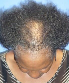 Prp Hair Therapy Before And After, Minoxidil Before And After Women, Prp Therapy, Prp Hair, Platelet Rich Plasma, Cape Fear, Hair Therapy, Fountain Of Youth, After Pictures