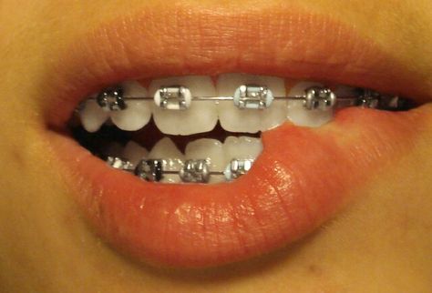 White Braces, Kawat Gigi, Teeth Aesthetic, Cute Braces Colors, Pretty Teeth, Adult Braces, Getting Braces, Orthodontic Appliances, Cute Braces