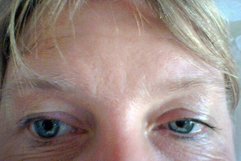 Why Are My Eyelids Drooping? | WebMD Flaky Skin On Face, Dry Eyelids, Droopy Eyelids, Dry Flaky Skin, Acute Care, Genetic Disorders, Flaky Skin, Puffy Eyes, Moisturizing Lotions