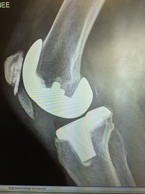 My knee cap has broken in half! The entire lower half of the patella is laying up against my knee replacement! Patella Fracture, Broken Knee, Knee Cap, Scammer Pictures, Knee Replacement, Healing, Quick Saves