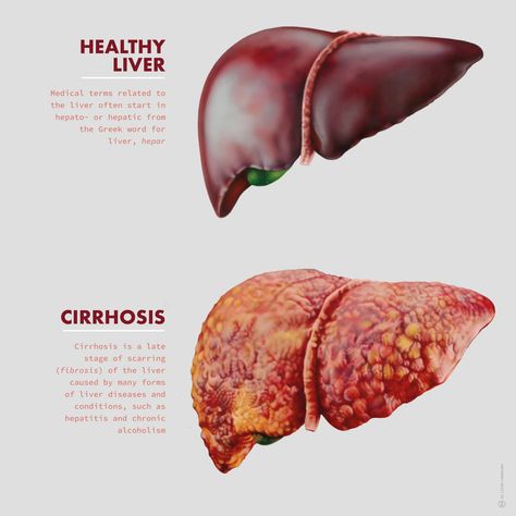 Medical illustration depicting the differences between a healthy liver and one with cirrhosis. Expertly illustrated by Linda Lubbersen, founder of #StudioLindalu. Explore more work by Studio Lindalu on the Medical Illustration & Animation Sourcebook online site. #scienceillustration #scienceart #scienceartist #scientificillustration #scientificvisualization #science #medicine #medicalillustration #illustration #anatomy #pathology #liver #cirrhosis #research #organs #health #disease #editorial Liver Anatomy Drawing, Liver Illustration, Organs Illustration, Human Liver Anatomy, Liver Organ, Human Body Science Projects, Illustration Anatomy, Liver Anatomy, Biology Anatomy