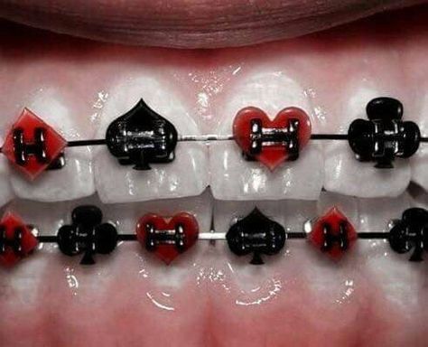 ♛ follow ya average girl for more pins ♛ Harley Quinzel, Cute Braces Colors, Misaligned Teeth, Braces Tips, Getting Braces, Cute Braces, Lizzie Hearts, Brace Face, Braces Colors