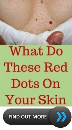 What do these red dots on your skin mean. Red Dots On Skin, What Is Health, Summer Health, Healthy Remedies, Health Signs, Women Health Care, Skin Tags, Health Tips For Women, Daily Health Tips