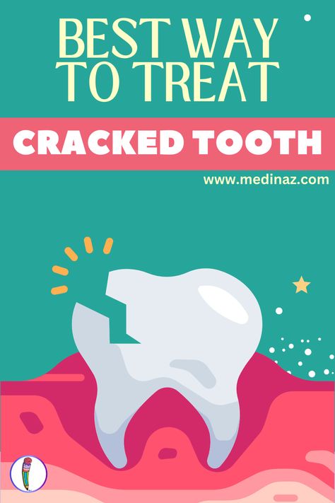 Best Way to Treat Cracked Tooth (Fractured Tooth) - A detailed guide Chipped Tooth Aesthetic, Chipped Tooth Repair, Baby Bottle Tooth Decay, Cracked Tooth, Chipped Tooth, Tooth Filling, Tooth Decay Remedies, Tooth Repair, Molar Tooth