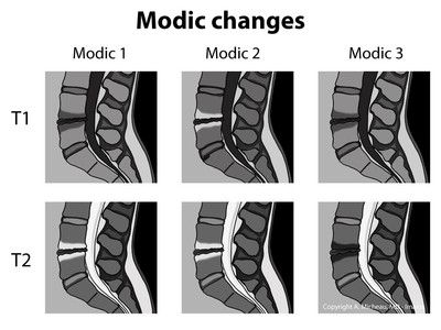 Spinal Degeneration, Mri Technologist, Radiology Student, Medical Mnemonics, Radiology Imaging, Spinal Surgery, Brain Anatomy, Spine Health, Spine Surgery