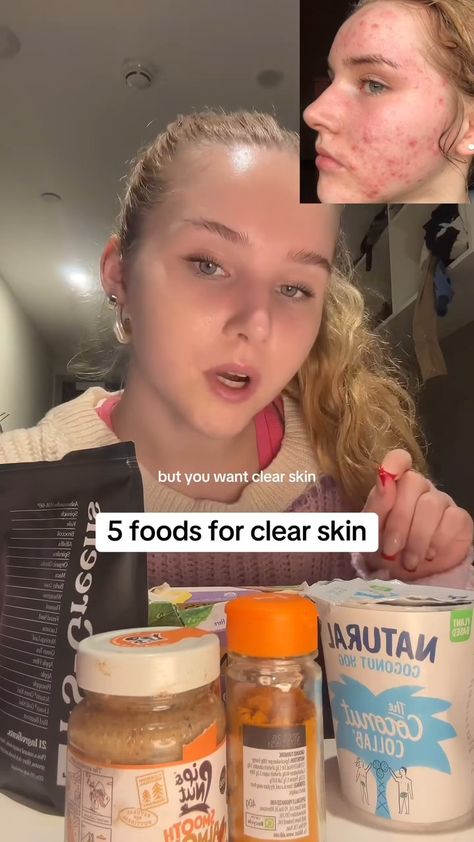 5 foods of clear skin Skin Care Whiteheads, Reasons Of Acne On Face, How To Improve Acne, Natural Acne Scar Remedy, Even Out Skin Tone Naturally, How Is Your Skin So Clear, How To Have Beautiful Skin, Make Up On Acne Skin, Tea For Acne Clear Skin