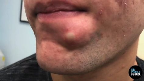 Dr. Sandra Lee, aka "Dr. Pimple Popper," said when a pimple pops "beautifully, it's like a love story." Dr Sandra Lee Pimple Popper Videos, Dr Pimple Popper Blackhead Youtube, Dr Pimple Poppìng Videos, Spot Popping Videos, Ear Pimple Poppìng Videos, Lip Blackheads, Leg Pimples, Big Pimple Poppìng Videos, Pimple Poppìng Videos New