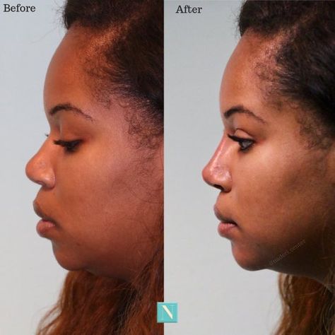 I Tried Out Nonsurgical Rhinoplasty And This Is What Happened - Society19 Nose Filler, Nonsurgical Nose Job, Nose Fillers, Crooked Nose, Cheek Fillers, Nose Job, Cosmetic Procedures, Perfect Sense, Lip Fillers