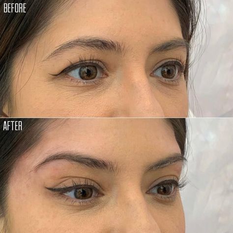 Botox Eyes, Eye Lift Surgery, Beauty Surgery, Brow Lift Surgery, Face Plastic Surgery, Botox Brow Lift, Pdo Threads, Botox Before And After, Botox Lips