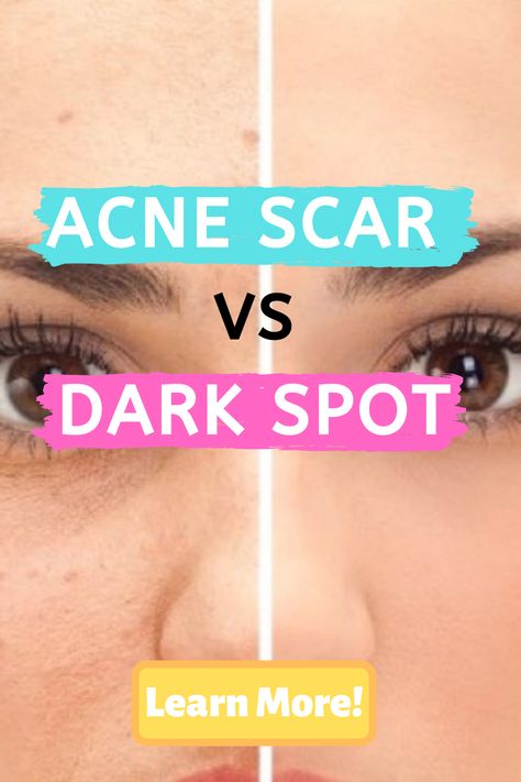 What is the difference between an acne scar and a dark spot? This is  one of our most frequently asked questions, and one of the biggest  misconceptions regarding post acne marks. #acne #acnescars #darkspots Pimples On Scalp, Cursed Doodles, Hypertrophic Scars, Blind Pimple, Pimples Under The Skin, Post Inflammatory Hyperpigmentation, Bad Acne, Post Acne Marks, Pimples Remedies