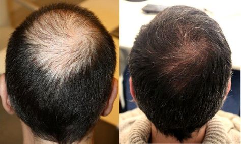 Mesotherapy Hair, Platelet Rich Plasma Therapy, Hair Transplant Women, Prp Hair, Dramatic Hair, Hydra Facial, Cosmetic Clinic, Platelet Rich Plasma, Hair Therapy