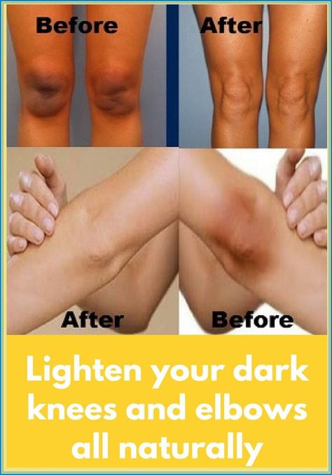 4 HOME REMEDIES TO GET RID OF BLACK KNEES AND ELBOW Chest Congestion, Dark Underarms, Dancer Workout, Back Pain Exercises, Black Knees, Health And Fitness Tips, Health Facts, Health Remedies, Holistic Health