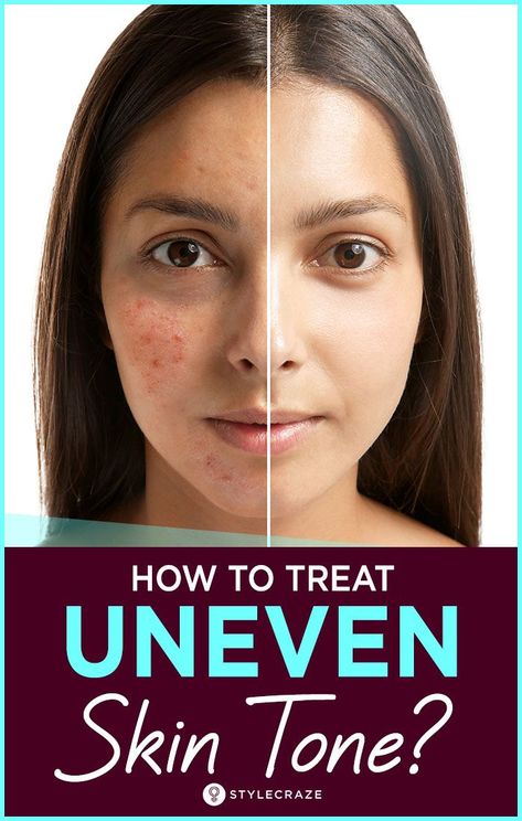 Uneven Skin Tone? Tips To Get Rid Of It Naturally #skin #care #skincare #beauty Uneven Skin Tone Remedies, Tone Face, Beauty Tips For Glowing Skin, Glow Skin, Skin Remedies, Even Out Skin Tone, Beauty Skin Care Routine, Face Skin Care, Uneven Skin