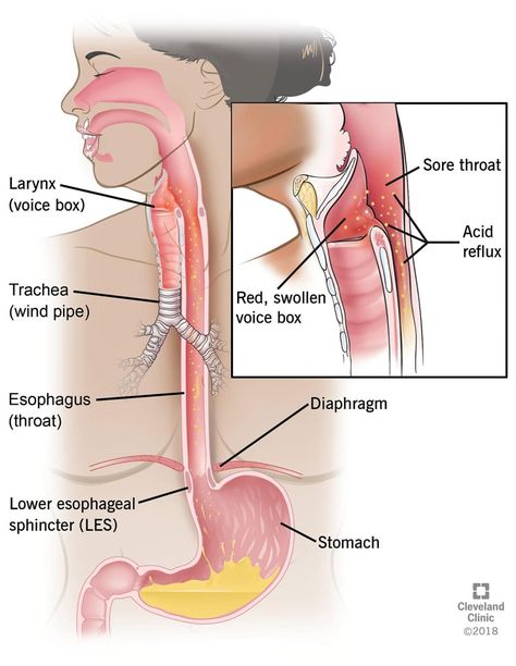 Post Nasal Drip Remedy Sore Throat, Drip Pictures, Lpr Diet, Dysphagia Therapy, Silent Reflux, Reflux Recipes, Reflux Remedies, Body Facts, Gastric Problem