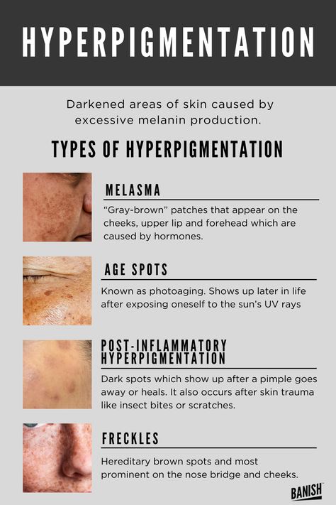 Best For Hyperpigmentation, Types Of Hyperpigmentation, Skincare Tips For Acne, Skin Education, Get Rid Of Hyperpigmentation, Tips For Acne, Remove Skin Tags Naturally, Forehead Acne, Post Inflammatory Hyperpigmentation