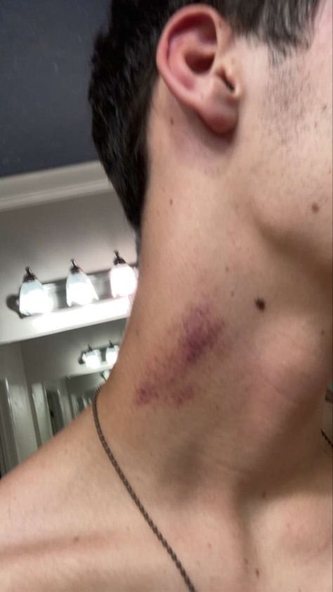 Hickies Neck Snapchat, Hickey On Boy, Hickey Neck Aesthetique, Love Bite Photos Real, Guy With Scratch On Back, Neck Bite Boyfriend, Love Bite Snap, Love Bites Hickey, Hickies Neck Aesthetic Guy