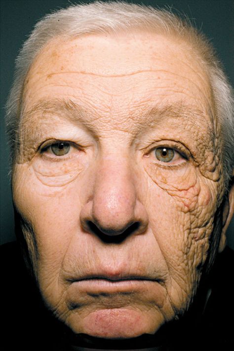 Sun Damage After 28 Years Of Driving A Delivery Truck Sun Damaged Skin, Wear Sunscreen, Sun Care, Diy Skin Care, Diy Skin, Truck Driver, Damaged Skin, Aging Skin, Sun Protection