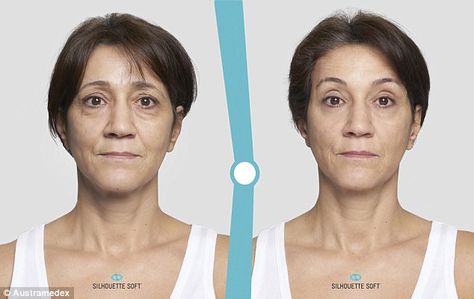 I HAD A THREAD LIFT - THIS IS WHAT HAPPENED - Thread Lift Face, Facelift Surgery, Face Threading, Facelift Procedure, Non Surgical Facelift, Anti Wrinkle Injections, Face Lift Surgery, Thread Lift, Subcutaneous Tissue