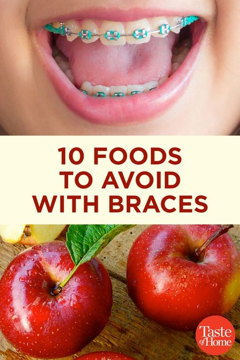 Braces Food To Avoid, Braces Food, Black Braces, Adult Braces, Kids Braces, Braces Tips, Getting Braces, Brace Face, Braces Colors