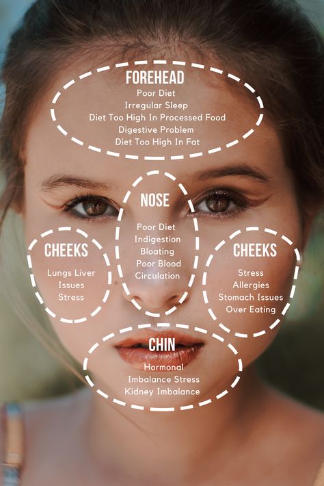 Doctor of traditional Chinese medicine believes that breakouts on varioys areas of the face can reflect different problems in your internal health. This face map will show your problem. Chinese Medicine Face Map, Chinese Medicine Doctor, Face Mapping Health, Chinese Face Map, Chinese Face Reading, Face Map, Internal Health, Tcm Traditional Chinese Medicine, Historical Recipes