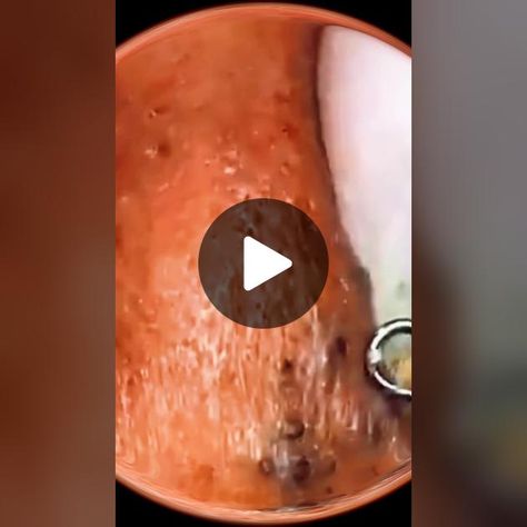 #squeeze #squeezeyuk #acne #pimple #pimlepop #blackhead #satisfying #f... | Satisfying Video | TikTok Squeezing Blackheads, Video Tiktok, Satisfying Video, Blackheads, Acne, Pins, Quick Saves