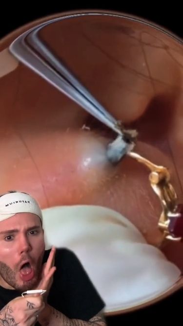 OMG! Never forget to clean your piercings. - LINK added of the BEST cleanser! DISCOUNT $$$ c;mattrandon #SelfCare #FitnessTips #FitLife #NutritionTips #HealthTips #HealthyLiving #HealthyLifestyle #Wellness Satisfying Zit Popping Videos, The Best Cleanser, Piercing Bump, Best Cleanser, Zit Popping Videos, Natural Acne Remedies, How To Get Rid Of Pimples, Piercing Aftercare, Natural Sleep Remedies