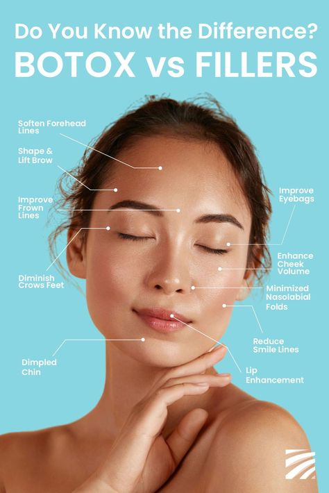 Botox Vs Fillers, Botox Under Eyes, Derma Fillers, Under Eye Fillers, Botox Before And After, Face Fillers, Hyaluronic Acid Fillers, Cheek Fillers, Wrinkle Filler