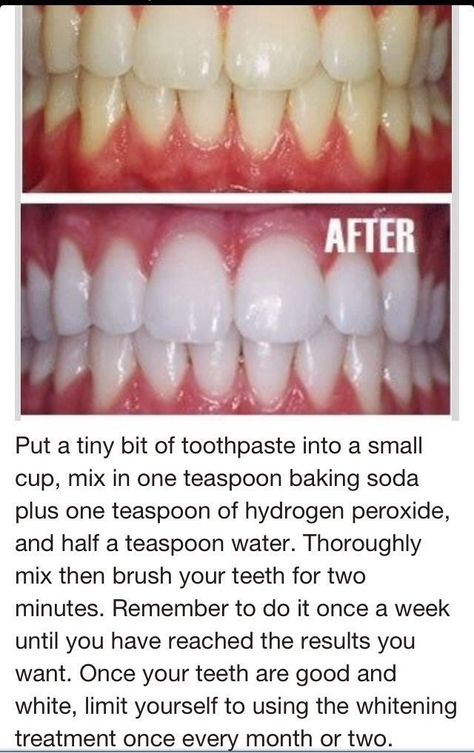 Home Remedy For Instantly White Teeth! Natural Teeth Whitening Diy, Kesehatan Gigi, Diy Coconut Oil, Teeth Whitening Remedies, Teeth Whitening Diy, Charcoal Teeth Whitening, Baking Soda Shampoo, Natural Teeth Whitening, Natural Teeth