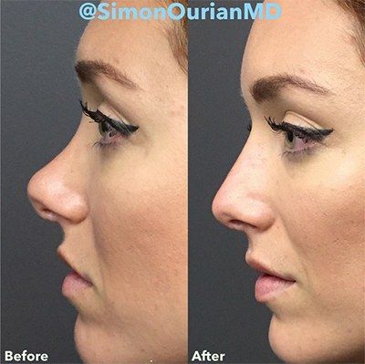 The Truth About Those 5-Minute Nonsurgical Nose Jobs That Have Everyone Freaking Out Nostril Reduction, Nonsurgical Nose Job, Nose Surgery Rhinoplasty, Nose Fillers, Bulbous Nose, Plastic Surgery Fail, Nose Jobs, Rhinoplasty Nose Jobs, Plastic Surgery Gone Wrong