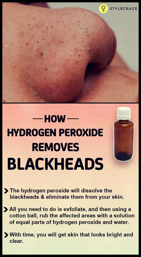 Black Heads, Get Rid Of Blackheads, Natural Cough Remedies, Hydrogen Peroxide, Natural Home Remedies, Health And Beauty Tips, Skin Tips, Blackhead Remover, Face Skin