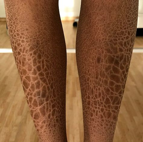 Holes In Skin Phobia, Ichthyosis Vulgaris, Scale Skin, Pattern Photography, Womens Health Care, Scaly Skin, Be With You Movie, Theatrical Makeup, Real Bodies