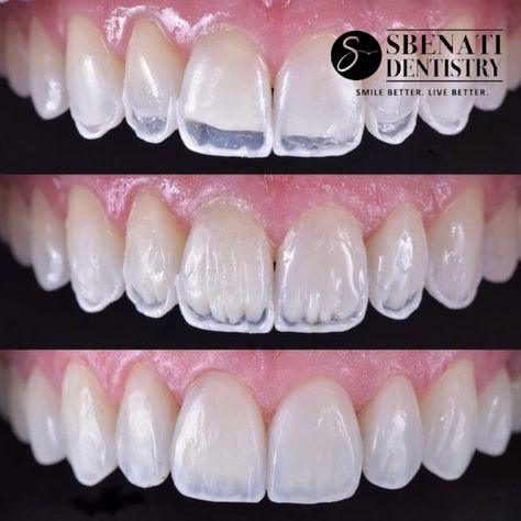 Pretty Teeth, Dental Videos, Dental Photography, Veneers Teeth, Dentistry Student, Beautiful Teeth, Aesthetic Dentistry, Dental Fillings, Dental Laboratory