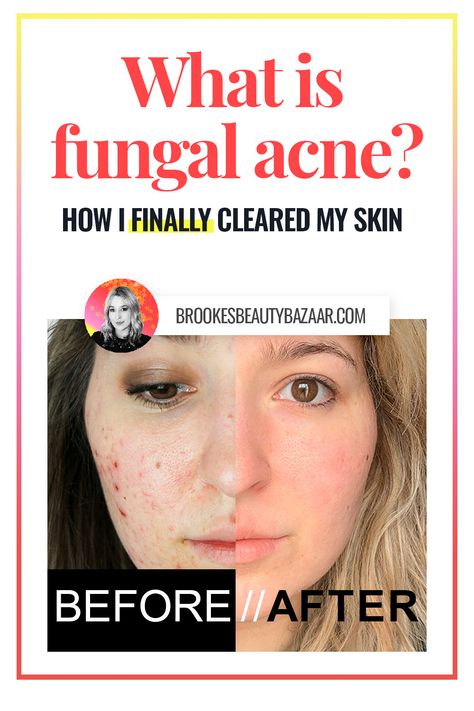 what is fungal acne? malassezia is actually a fungus that feeds on certain ingredients in your skincare and makeup products.. yikes! Unchecked, this fungus will spread over your face & body, causing a bumpy skin-tone rash (forehead bumps), or even worse - acne pustules! Luckily it's treatable without harsh chemicals or harmful medications. Find out how to get clear, glowing skin free from fungal acne on the blog.. #fungalacne #malassezia #acne #clearksin Acne On Forehead Reasons For, Acne Safe Blush, Fungle Acne, Bumpy Forehead, Treat Fungal Acne, Forehead Breakout, Bacterial Acne, Makeup For Acne, Forehead Bumps